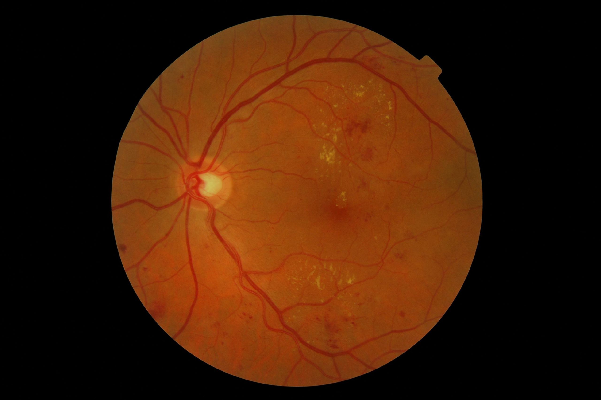 Ocular disease management in Brampton and Mississauga